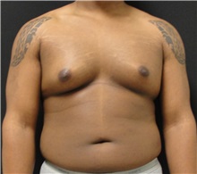 Male Breast Reduction Before Photo by Dzifa Kpodzo, MD; Albany, GA - Case 33008