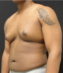 Male Breast Reduction Before Photo by Dzifa Kpodzo, MD; Albany, GA - Case 33008