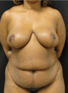 Tummy Tuck Before Photo by Dzifa Kpodzo, MD; Albany, GA - Case 33009