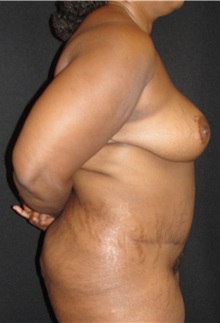 Tummy Tuck After Photo by Dzifa Kpodzo, MD; Albany, GA - Case 33009