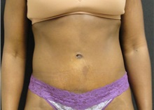 Tummy Tuck After Photo by Dzifa Kpodzo, MD; Albany, GA - Case 33010