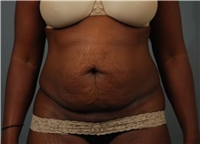 Tummy Tuck Before Photo by Dzifa Kpodzo, MD; Atlanta, GA - Case 33010