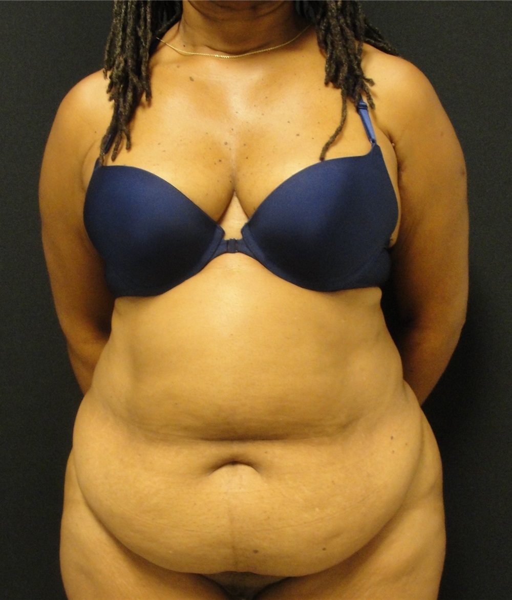 Tummy Tuck Before and After Photos by Dzifa Kpodzo, MD; Albany, GA - Case  33011