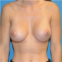 Breast Augmentation After Photo by Joshua Cooper, MD; Seattle, WA - Case 34334