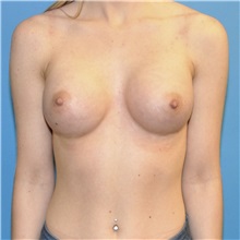 Breast Augmentation After Photo by Joshua Cooper, MD; Seattle, WA - Case 34339