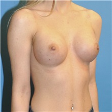 Breast Augmentation After Photo by Joshua Cooper, MD; Seattle, WA - Case 34339