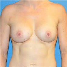 Breast Augmentation After Photo by Joshua Cooper, MD; Seattle, WA - Case 34366