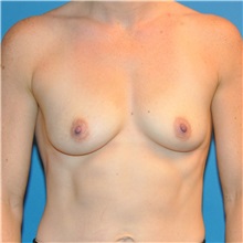 Breast Augmentation Before Photo by Joshua Cooper, MD; Seattle, WA - Case 34366