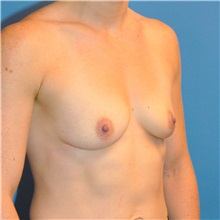 Breast Augmentation Before Photo by Joshua Cooper, MD; Seattle, WA - Case 34366