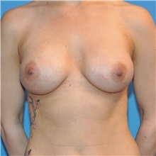 Breast Augmentation After Photo by Joshua Cooper, MD; Seattle, WA - Case 34369