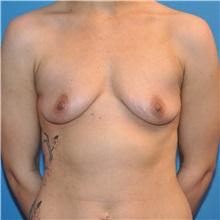 Breast Augmentation Before Photo by Joshua Cooper, MD; Seattle, WA - Case 34369