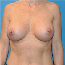 Breast Augmentation After Photo by Joshua Cooper, MD; Seattle, WA - Case 34371
