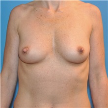 Breast Augmentation Before Photo by Joshua Cooper, MD; Seattle, WA - Case 34371