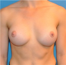 Breast Augmentation After Photo by Joshua Cooper, MD; Seattle, WA - Case 34374