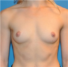 Breast Augmentation Before Photo by Joshua Cooper, MD; Seattle, WA - Case 34374