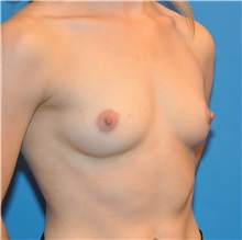 Breast Augmentation Before Photo by Joshua Cooper, MD; Seattle, WA - Case 34374