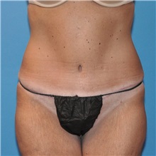 Tummy Tuck After Photo by Joshua Cooper, MD; Seattle, WA - Case 34514