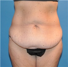 Tummy Tuck Before Photo by Joshua Cooper, MD; Seattle, WA - Case 34514