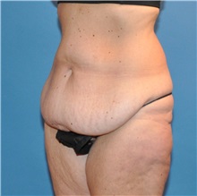 Tummy Tuck Before Photo by Joshua Cooper, MD; Seattle, WA - Case 34514