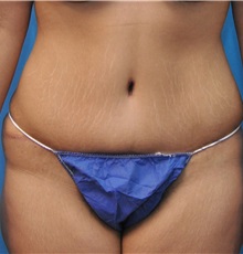 Tummy Tuck After Photo by Joshua Cooper, MD; Seattle, WA - Case 34516