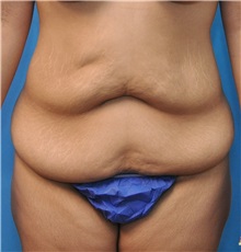 Tummy Tuck Before Photo by Joshua Cooper, MD; Seattle, WA - Case 34516