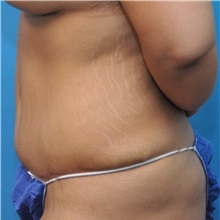 Tummy Tuck After Photo by Joshua Cooper, MD; Seattle, WA - Case 34516