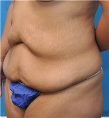 Tummy Tuck Before Photo by Joshua Cooper, MD; Seattle, WA - Case 34516