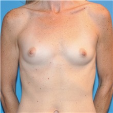 Breast Augmentation Before Photo by Joshua Cooper, MD; Seattle, WA - Case 34518