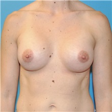 Breast Augmentation After Photo by Joshua Cooper, MD; Seattle, WA - Case 34521