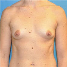 Breast Augmentation Before Photo by Joshua Cooper, MD; Seattle, WA - Case 34521