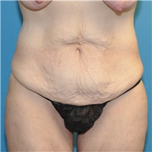 Tummy Tuck Before Photo by Joshua Cooper, MD; Seattle, WA - Case 34586