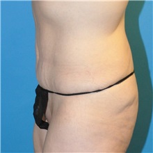 Tummy Tuck After Photo by Joshua Cooper, MD; Seattle, WA - Case 34586