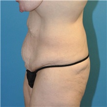 Tummy Tuck Before Photo by Joshua Cooper, MD; Seattle, WA - Case 34586