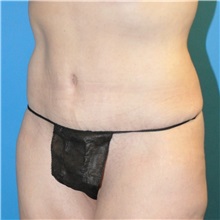 Tummy Tuck After Photo by Joshua Cooper, MD; Seattle, WA - Case 34586