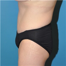 Tummy Tuck After Photo by Joshua Cooper, MD; Seattle, WA - Case 34587