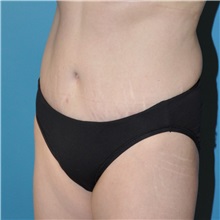 Tummy Tuck After Photo by Joshua Cooper, MD; Seattle, WA - Case 34587