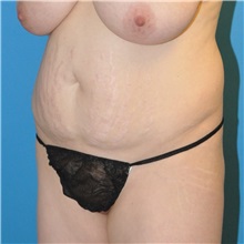 Tummy Tuck Before Photo by Joshua Cooper, MD; Seattle, WA - Case 34587