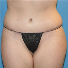 Tummy Tuck After Photo by Joshua Cooper, MD; Seattle, WA - Case 34588