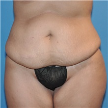 Tummy Tuck Before Photo by Joshua Cooper, MD; Seattle, WA - Case 34588