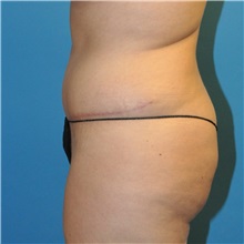Tummy Tuck After Photo by Joshua Cooper, MD; Seattle, WA - Case 34588