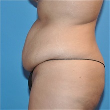 Tummy Tuck Before Photo by Joshua Cooper, MD; Seattle, WA - Case 34588