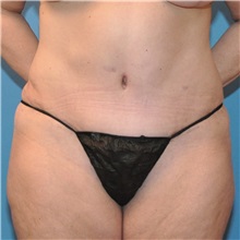 Tummy Tuck After Photo by Joshua Cooper, MD; Seattle, WA - Case 34589