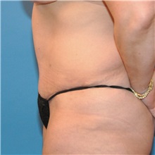 Tummy Tuck After Photo by Joshua Cooper, MD; Seattle, WA - Case 34589