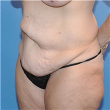 Tummy Tuck Before Photo by Joshua Cooper, MD; Seattle, WA - Case 34589