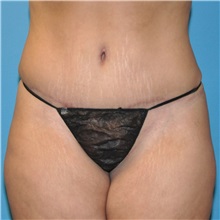 Tummy Tuck After Photo by Joshua Cooper, MD; Seattle, WA - Case 34590