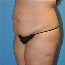 Tummy Tuck Before Photo by Joshua Cooper, MD; Seattle, WA - Case 34590