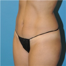 Tummy Tuck After Photo by Joshua Cooper, MD; Seattle, WA - Case 34599