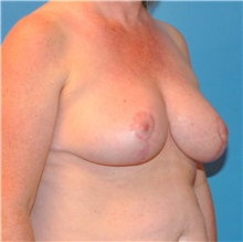 Breast Reduction After Photo by Joshua Cooper, MD; Seattle, WA - Case 34635