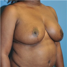 Breast Reduction After Photo by Joshua Cooper, MD; Seattle, WA - Case 34642