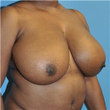 Breast Reduction Before Photo by Joshua Cooper, MD; Seattle, WA - Case 34642